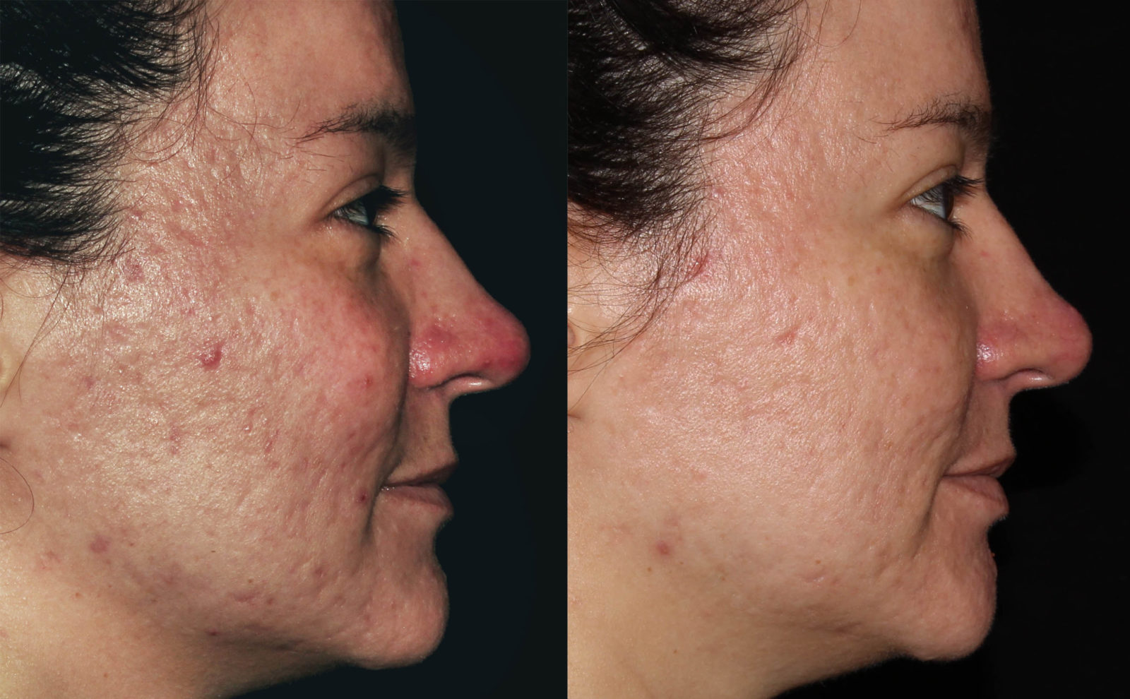 Bellafill Filler to Fill in Scars